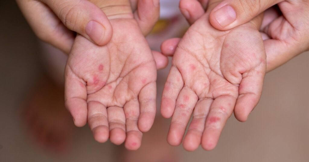 80% ca bệnh tay chân miệng chủng EV71 thuộc nhóm trẻ em dưới 5 tuổi